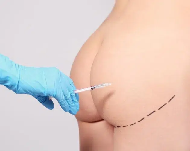 Inicio Lipoinyeccion Glutea