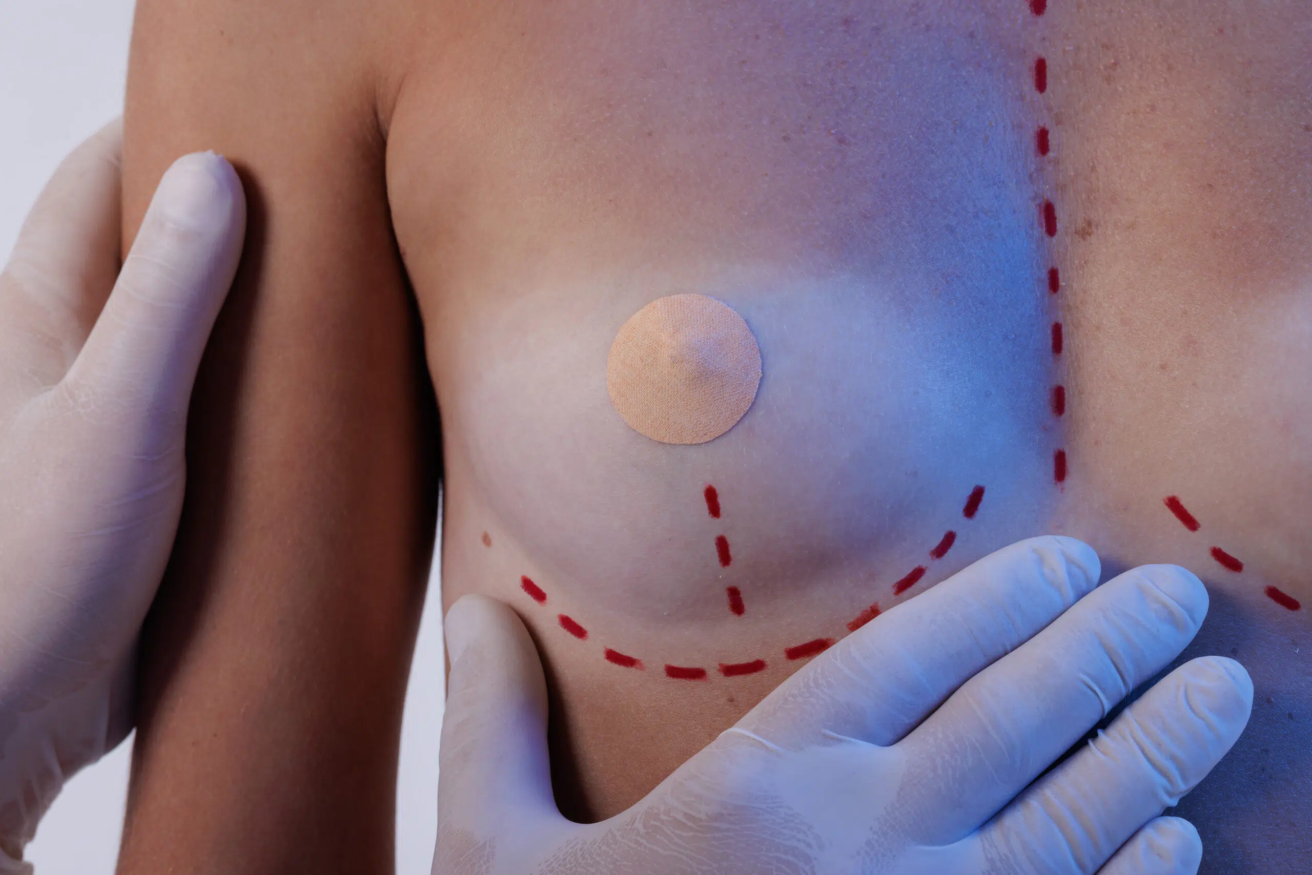 Plastic Surgeon Drawing Marks On Female Breast Bef 2025 03 18 17 24 58 Utc Scaled